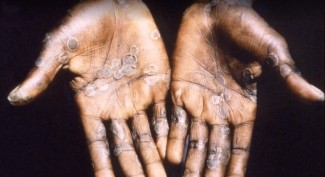 Nzay's Insight on VOA: The Mpox Crisis in the Hardest-Hit DRC